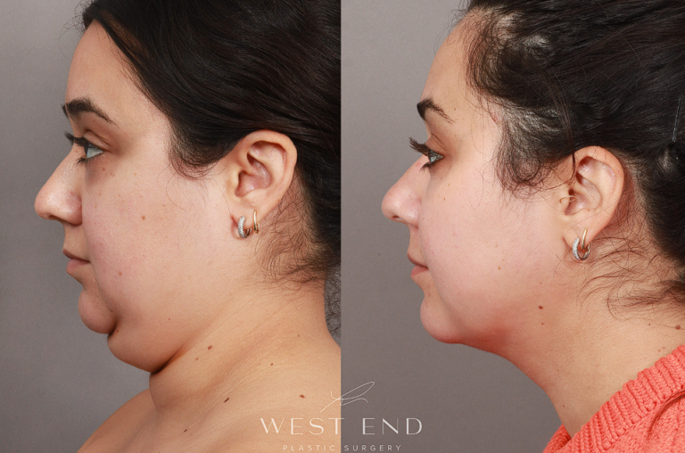 What is J Plasma - Before and After Photos, Details about Skin Tightening